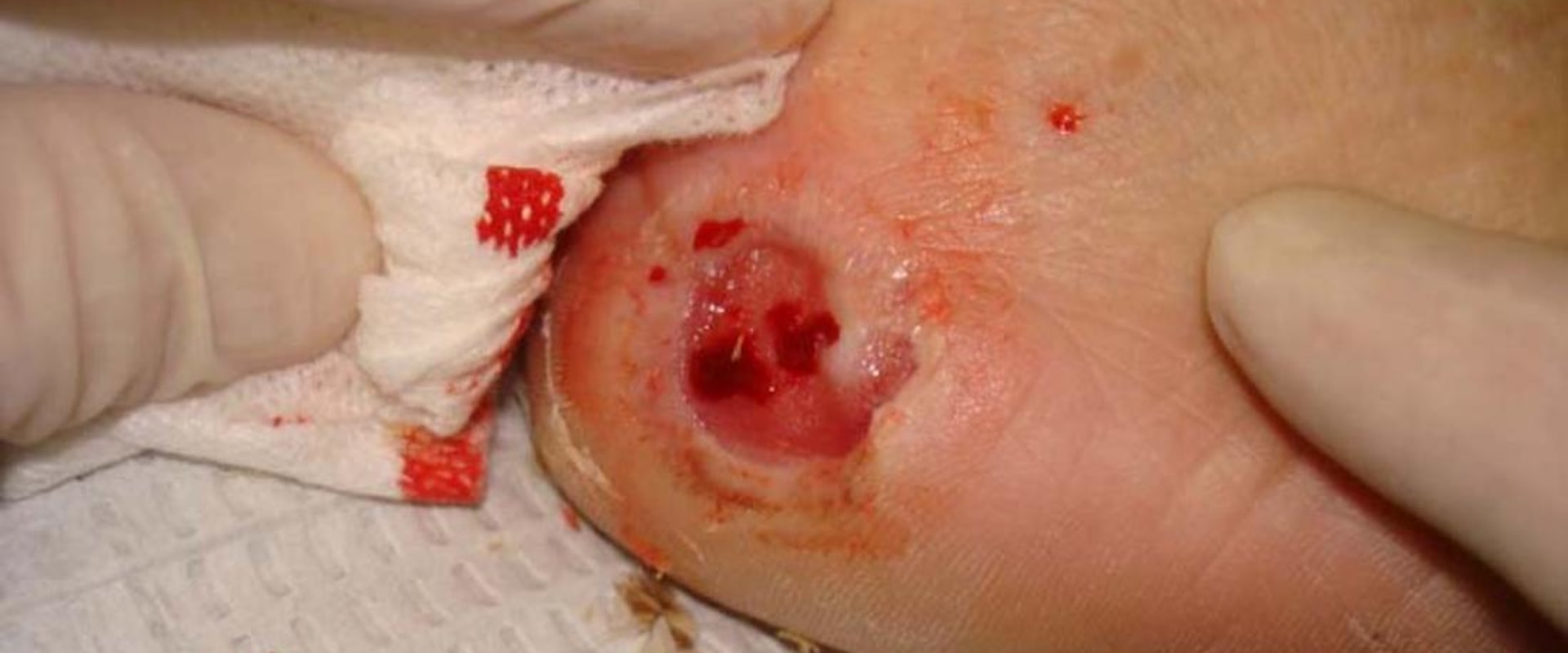 Effective Ways to Relieve Skin Ulcer Symptoms